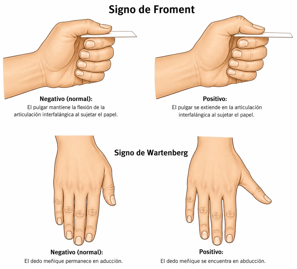 Signo de Wartenberg en lesión del nervio cubital