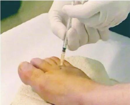 Infiltración local en neuroma de Morton
