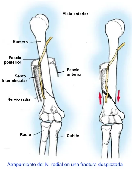 Parálisis del nervio radial