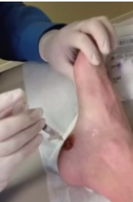 Infiltración de corticosteroides