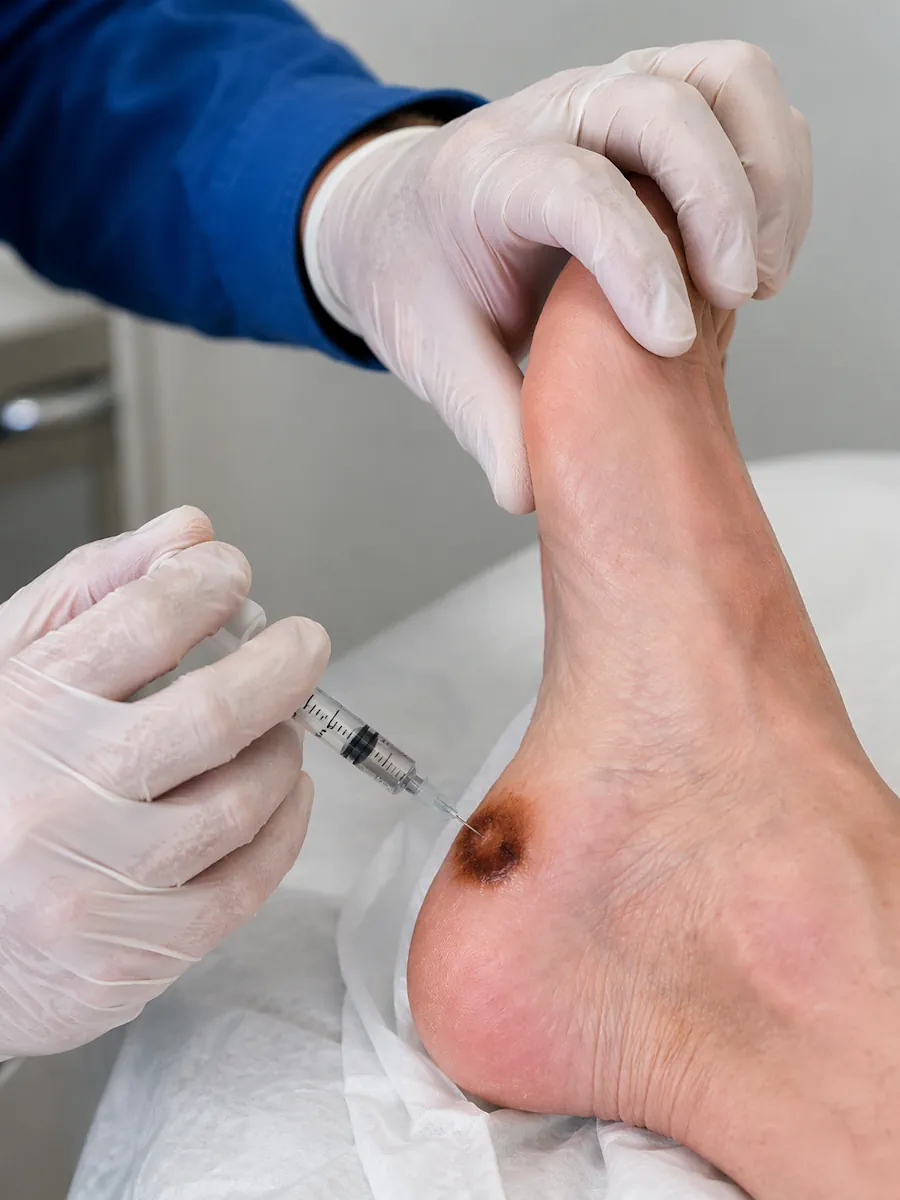 Infiltración en fascitis plantar