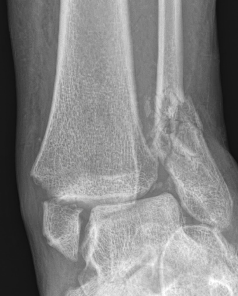 Radiografía en fractura de tobillo