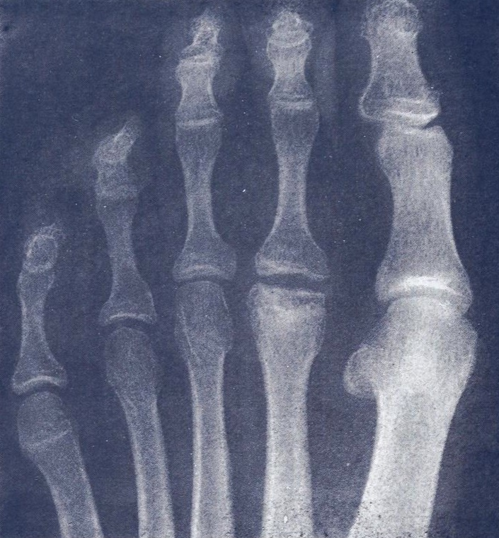 Radiografía de enfermedad de Freiberg en la cabeza metatarsiana