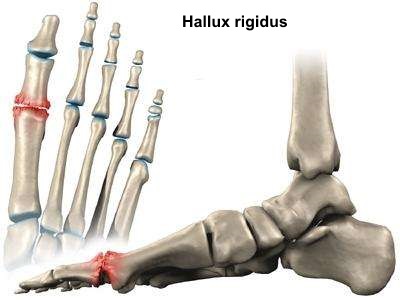Hallux rigidus