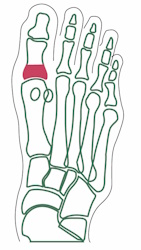 Técnica de Keller - Imagen 1
