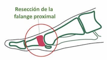 Técnica de Keller - Imagen 2