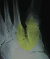 Radiografía de antepié con sobrecarga metatarsal