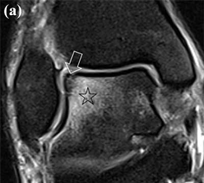Resonancia magnética de una lesión osteocondral del astrágalo