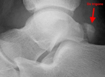 Os trigonum como ejemplo de variante posterior que no explica un pinzamiento anterior