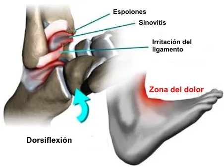 Localización clínica del dolor anterior de tobillo