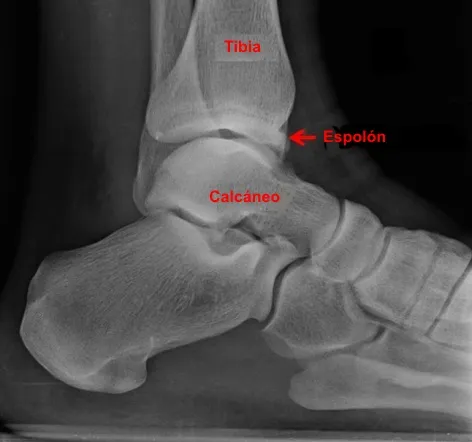 Radiografía con osteofitos anteriores del tobillo