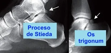 Radiografía lateral en pinzamiento posterior del tobillo