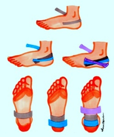 Taping plantar