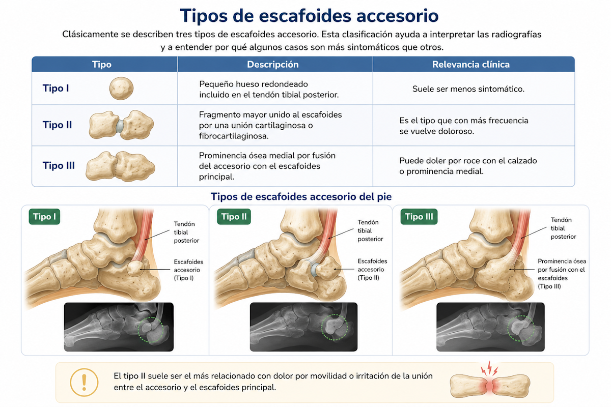 Tipos de escafoides accesorio del pie