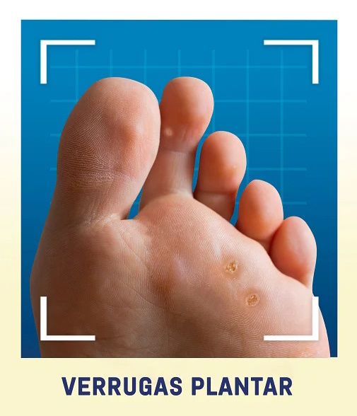 Verrugas plantares