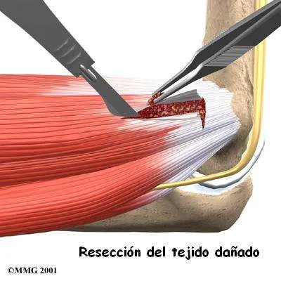 Cirugía de epitrocleitis 2