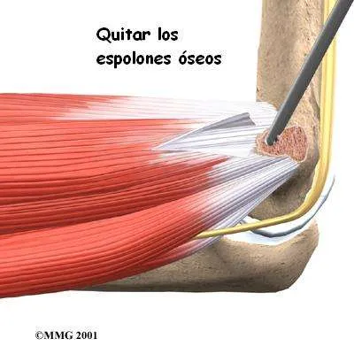Cirugía de epitrocleitis 3