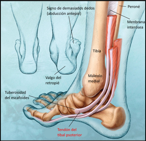 Signo de Too many toes: visión de más dedos del pie desde atrás debido a la abducción del antepié