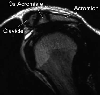 Radiografía OS acromiale