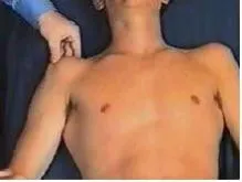 Infiltración del subescapular 1
