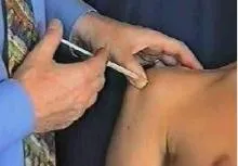 Infiltración del subescapular 2