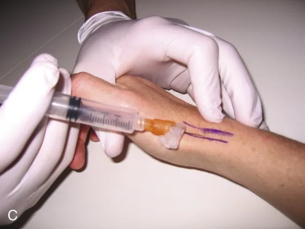 Infiltración del primer compartimento extensor en De Quervain