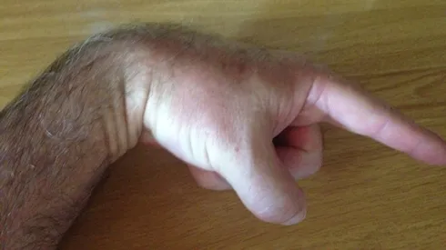 Dolor dorsal de muñeca