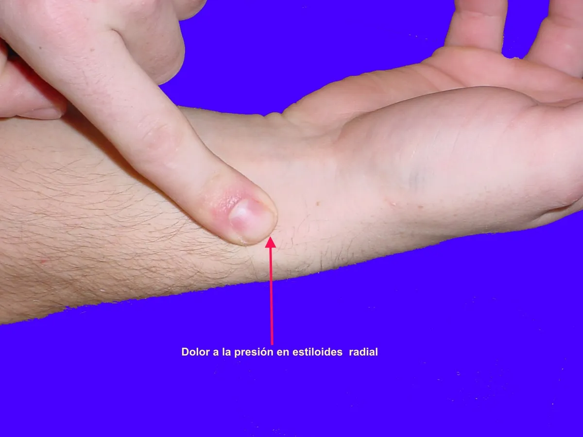 Dolor en la estiloides radial