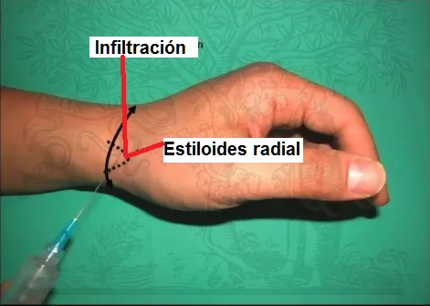 Infiltración en la estiloides radial
