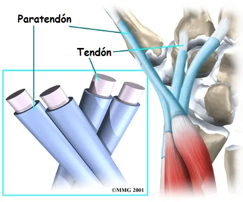 Bursitis en síndrome de intersección