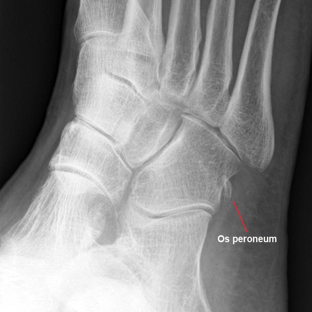 Os peroneum desplazado en ruptura tendón peroneo largo