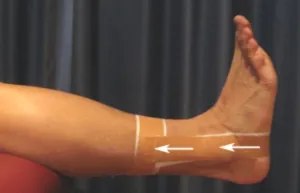 Taping y soporte en rehabilitación de peroneos