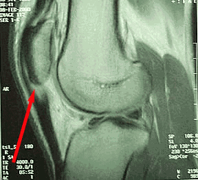 Resonancia magnética de rodilla