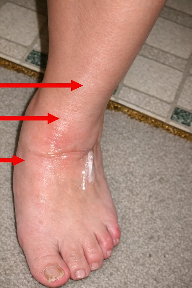 Tendinitis del tibial anterior