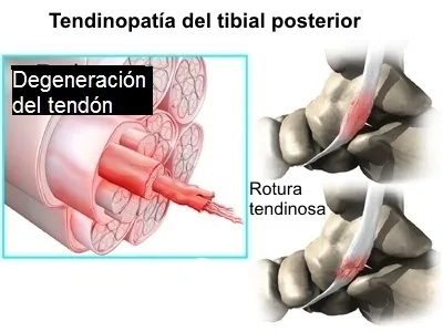 Estadios de la disfunción del tibial posterior